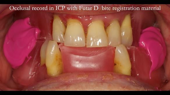 Finlay's Case Study Newsletter 40 - Immediate Mk 1 RPD to Definitive Mk 2 RPD - full protocol