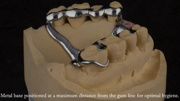 Finlay's Newsletter 63 Case study provision of metal based Scandinavian RPD - functional 10 years on