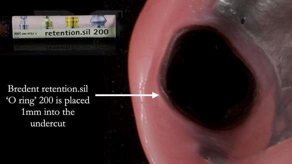 Finlay's Newsletter 58 Gasket upper partial denture for Zoe