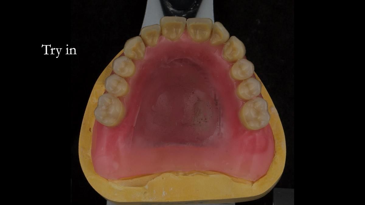 Newsletter 87 – Father Peter: A Partial Denture that needed Minor Miracle