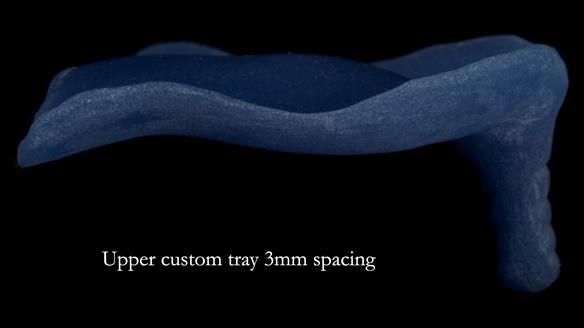 Newsletter 83: Sheila’s Complete Denture Success