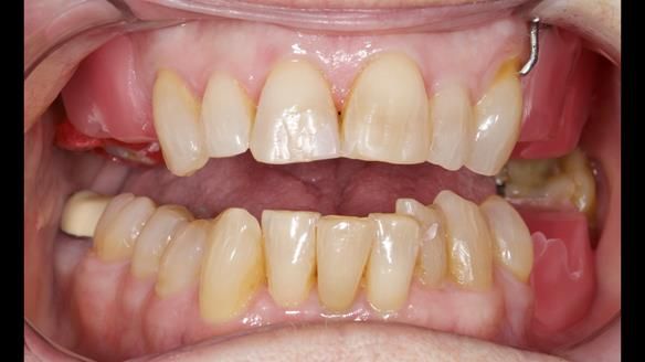 Finlay's Newsletter 60 Sylvia's upper Kennedy Class 2 Mod 1 metal based upper RPD