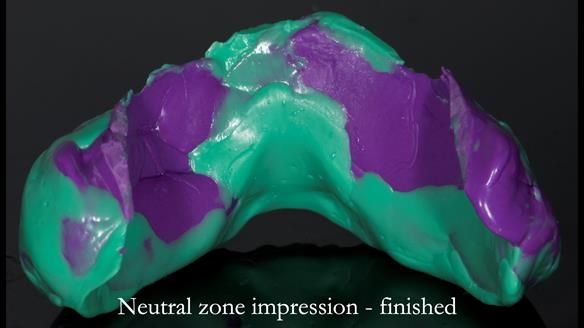 Newsletter 83: Sheila’s Complete Denture Success