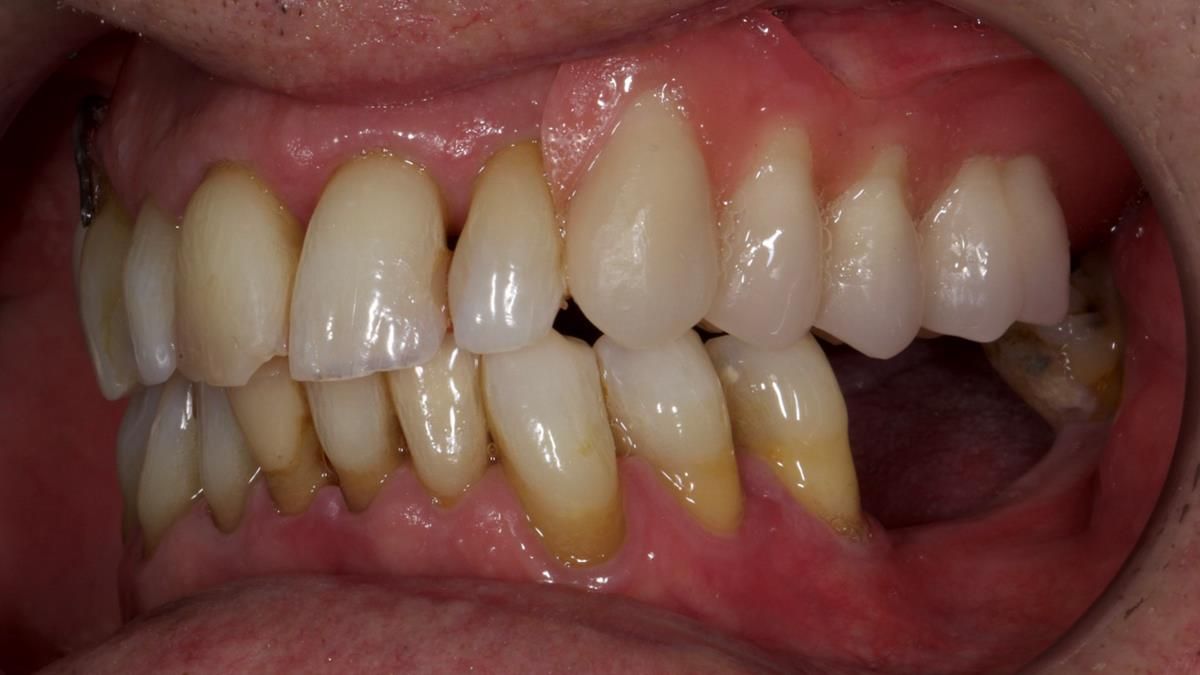 Newsletter 89 – Simon: A Challenging Kennedy Class II Division 1 Upper CoCr Partial Denture with a High Smile Line