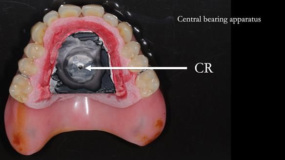 Newsletter 54 case presentation upper complete denture and lower Scandinavian designed hygienic partial denture for David