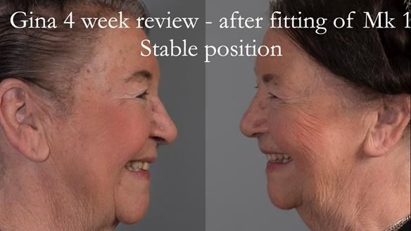 Finlay's Case Study Newsletter 40 - Immediate Mk 1 RPD to Definitive Mk 2 RPD - full protocol