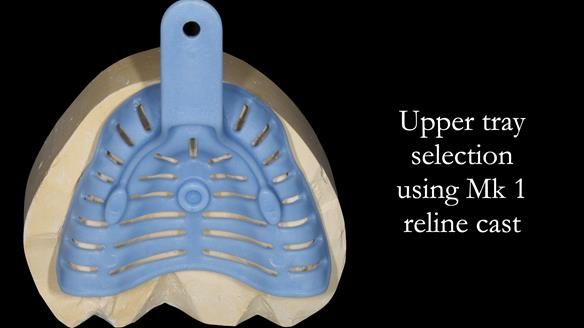 Newsletter 52 Managing Jo’s failing dentition with extractions and Mk 1/Mk 2 complete upper dentures and lower partial dentures FULL PROTOCOL