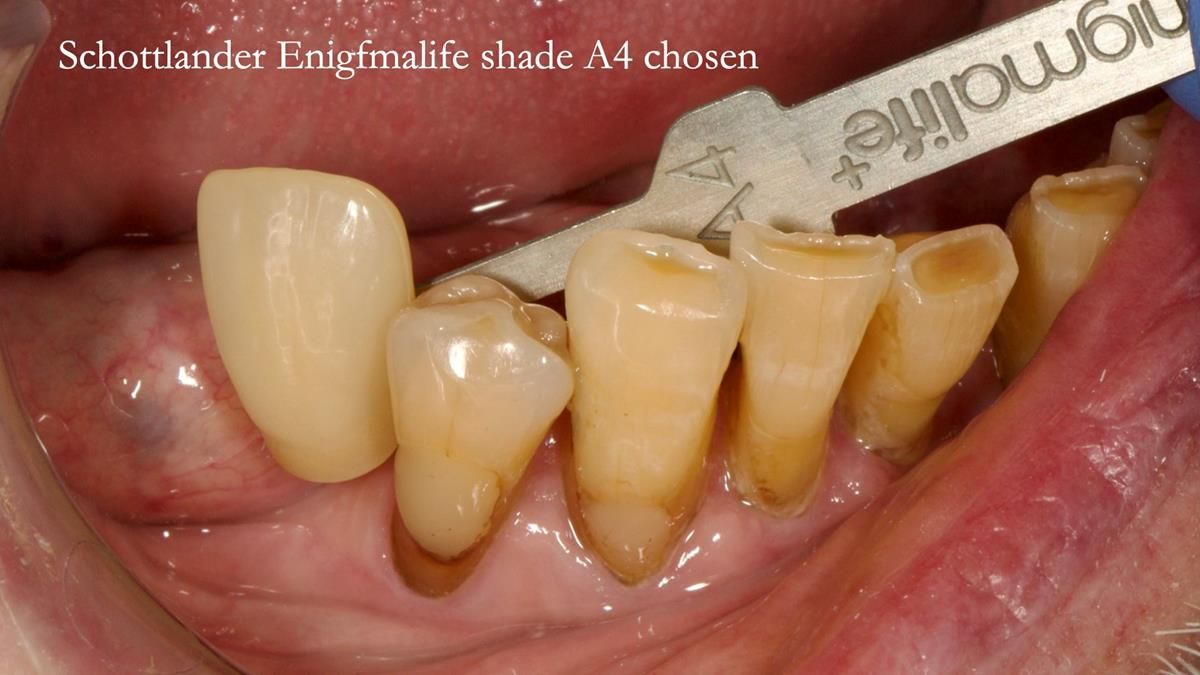 Newsletter 87 – Father Peter: A Partial Denture that needed Minor Miracle