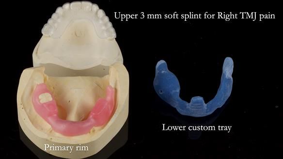 Newsletter 82 Mary - A complete upper and a one-tooth gasket denture