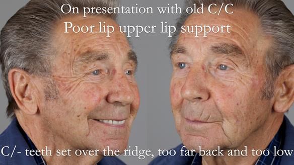 Newsletter 50 Special edition Complete Dentures FULL PROTOCOL