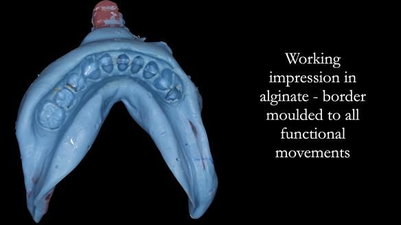 Newsletter 52 Managing Jo’s failing dentition with extractions and Mk 1/Mk 2 complete upper dentures and lower partial dentures FULL PROTOCOL