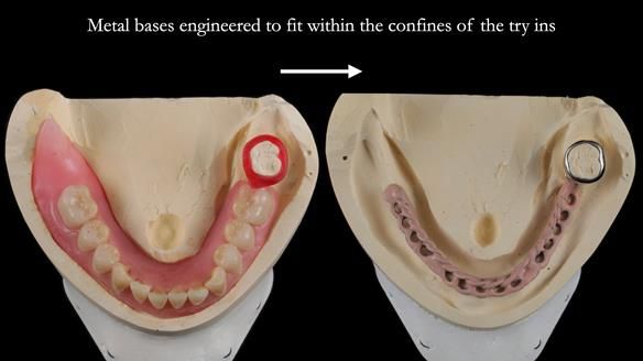Finlay's Newsletter 59 Ultra hard partial dentures made for Gill