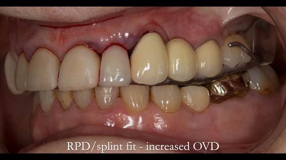 Newsletter 51 Managing Anne’s failing dentition with distal extension base RPD/Splint FULL PROTOCOL