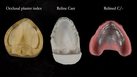 Newsletter 77: Jeremy’s case – immediate complete upper denture