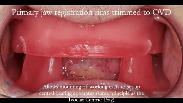 Finlay's Newsletter 62 provision of extractions and metal based complete dentures for Rafique