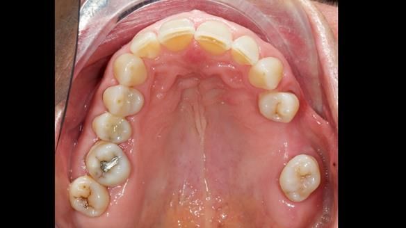 Finlay's Newsletter 61 provision of a lower unilateral free end saddle metal based partial denture for Joyce