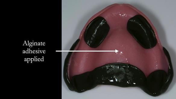 Newsletter 75: Marion’s case - Step-by-step complete denture workflow