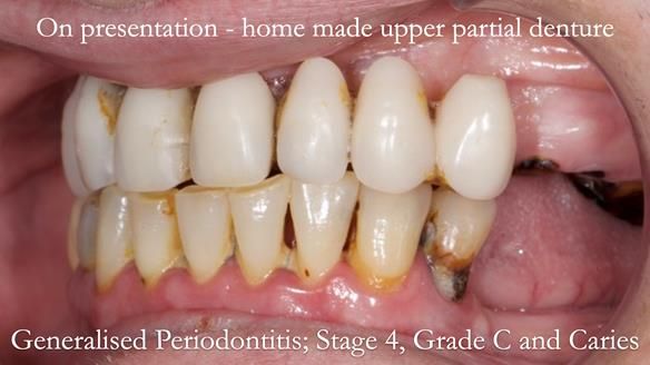 Newsletter 52 Managing Jo’s failing dentition with extractions and Mk 1/Mk 2 complete upper dentures and lower partial dentures FULL PROTOCOL