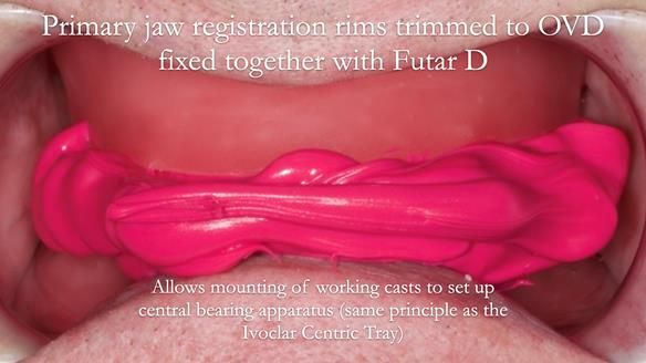 Newsletter 57 showcases the making and fitting process of implant-supported complete dentures for Alisdair