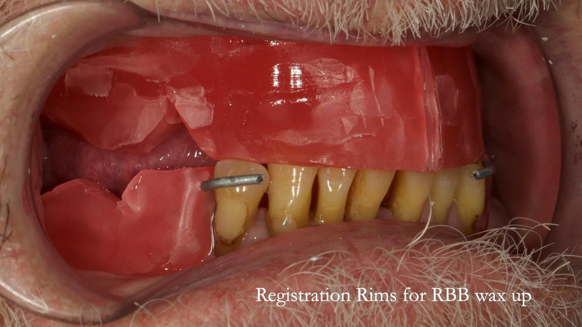 Newsletter 87 – Father Peter: A Partial Denture that needed Minor Miracle