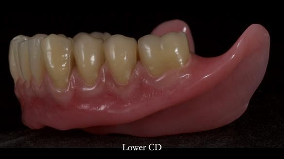 Newsletter 83: Sheila’s Complete Denture Success