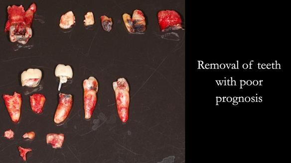 Newsletter 52 Managing Jo’s failing dentition with extractions and Mk 1/Mk 2 complete upper dentures and lower partial dentures FULL PROTOCOL