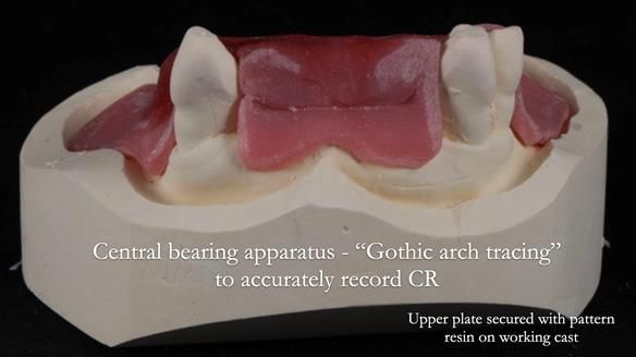 Finlay's Newsletter 59 Ultra hard partial dentures made for Gill