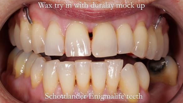 Newsletter 56 showing the making and fitting of a bilateral free end saddle upper removable partial denture (RPD) for patient with pemphigus
