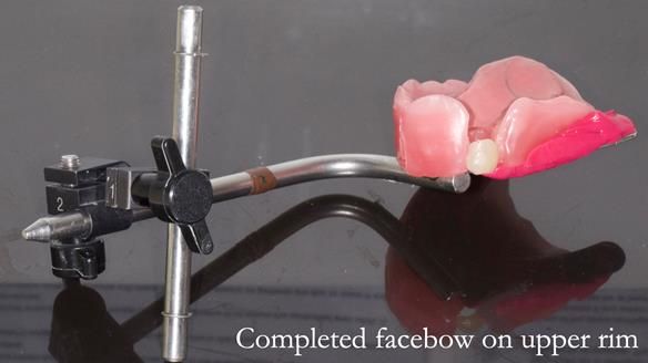 Newsletter 55 Provision of metal based partial dentures for Zephyrine with a repaired cleft lip and palate