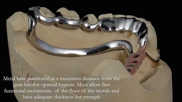 Finlay's Newsletter 61 provision of a lower unilateral free end saddle metal based partial denture for Joyce