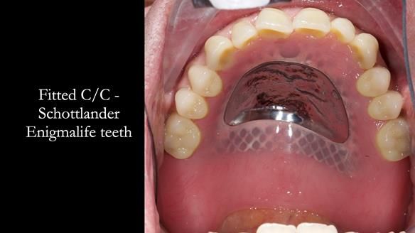 Complete denture Class II div 2 deep overbite Newsletter 39
