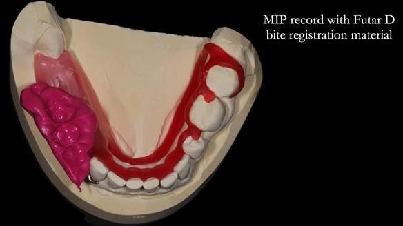 Finlay's Newsletter 61 provision of a lower unilateral free end saddle metal based partial denture for Joyce