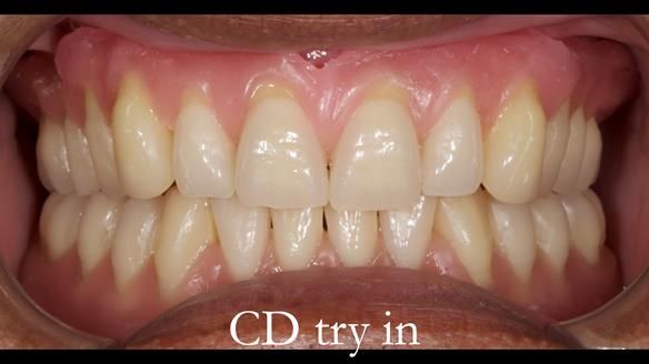Finlay's Newsletter 62 provision of extractions and metal based complete dentures for Rafique