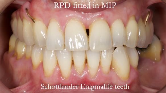 Newsletter 56 showing the making and fitting of a bilateral free end saddle upper removable partial denture (RPD) for patient with pemphigus