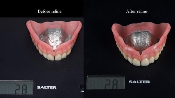 Newsletter 78: What do Clark Gable and a Locator® overdenture have in common?