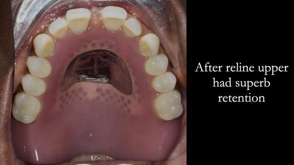 Newsletter 53 showing the making and fitting of ultra life-like dentures for Valena