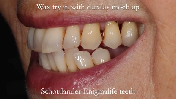 Newsletter 56 showing the making and fitting of a bilateral free end saddle upper removable partial denture (RPD) for patient with pemphigus