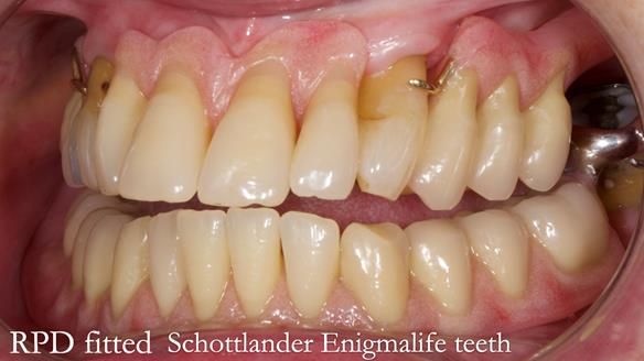 Finlay's Newsletter 59 Ultra hard partial dentures made for Gill