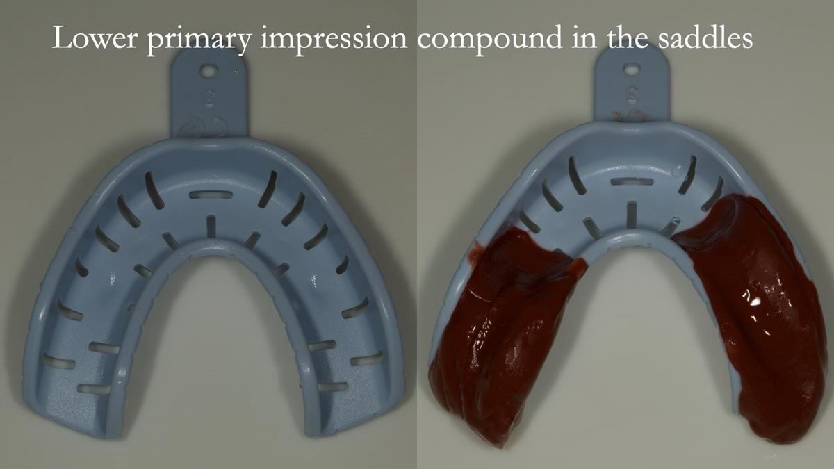 Newsletter 87 – Father Peter: A Partial Denture that needed Minor Miracle
