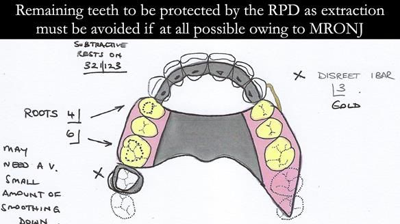 Finlay's Newsletter 60 Sylvia's upper Kennedy Class 2 Mod 1 metal based upper RPD
