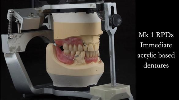 Finlay's Case Study Newsletter 40 - Immediate Mk 1 RPD to Definitive Mk 2 RPD - full protocol
