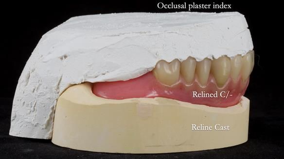 Newsletter 54 case presentation upper complete denture and lower Scandinavian designed hygienic partial denture for David