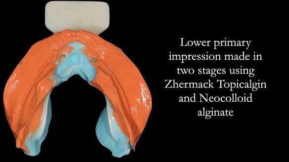 Managing poor implant positioning with complete dentures and Locator attachments - full protocol Newsletter 41