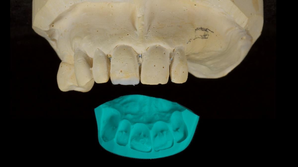 Newsletter 89 – Simon: A Challenging Kennedy Class II Division 1 Upper CoCr Partial Denture with a High Smile Line