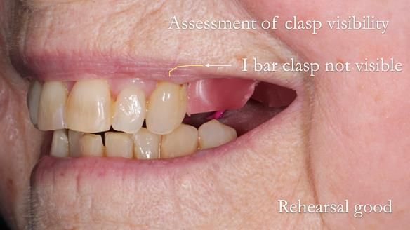 Finlay's Newsletter 60 Sylvia's upper Kennedy Class 2 Mod 1 metal based upper RPD