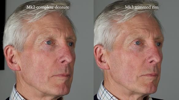 Newsletter 77: Jeremy’s case – immediate complete upper denture