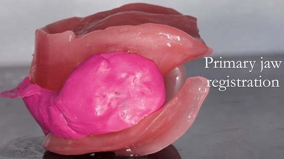 Replacing Madeline’s Complete denture FULL PROTOCOL