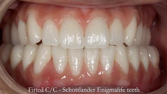Managing poor implant positioning with complete dentures and Locator attachments - full protocol Newsletter 41