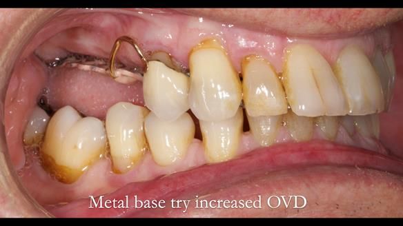 Finlay's Newsletter 64 case study - provision of a Kennedy class 2 metal based Scandinavian RPD for Ian