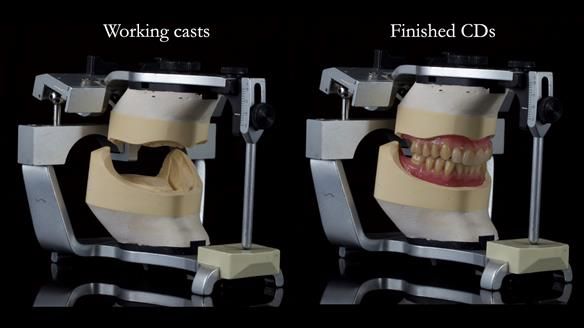 Newsletter 83: Sheila’s Complete Denture Success